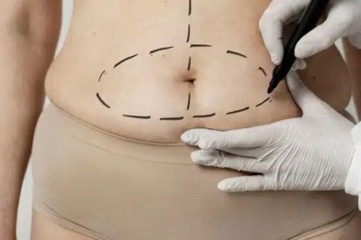 Ultimate FAQ Guide About Tummy Tuck in Dubai