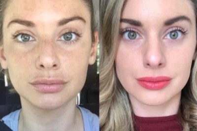 Smooth and Firm Skin with the Best Plastic Surgeons in Dubai for RF Microneedling