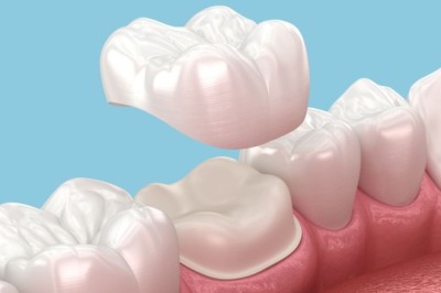 Benefits of Tooth Crown Dubai for Restoring Damaged Teeth