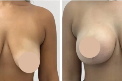 Choosing the Best Breast Reduction Surgeons in dubai for Lasting Results