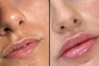Professional Facial Fillers Treatments in Dubai