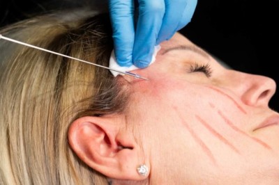 Everything You Need to Know About Thread lift in dubai