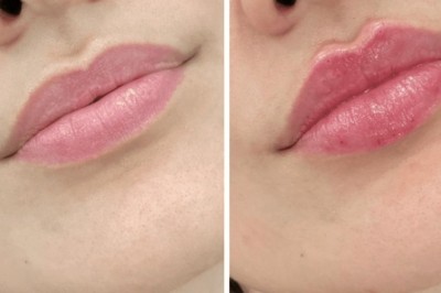 Juvederm for Non-Surgical Facelift by the Best Plastic Surgeons in Dubai