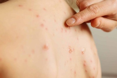 How to Prevent Bacterial Infections