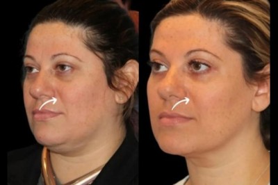 Best Doctors in Dubai Share Sculptra for Hydration Support