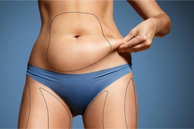 Abdominoplasty Dubai After Weight Loss: Is It the Right Option for Loose Skin?