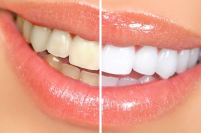 Teeth Whitening Bikaner: Achieve a Brighter Smile and Renew Your Confidence