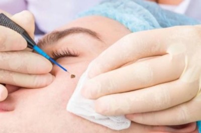 Mole Removal Procedure Explained in Simple Terms