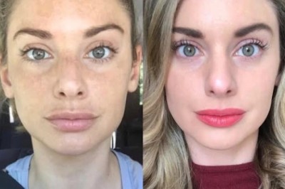 Radiofrequency (RF) Microneedling in Dubai for Advanced Skin Tightening