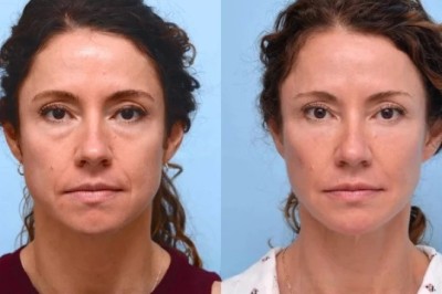 Best Doctors in Dubai Delivering Comprehensive Cosmetic Thread Lift Treatments