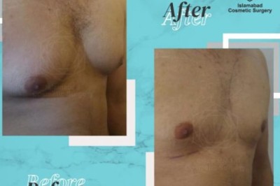 Who Is the Right Candidate for Gynecomastia Surgery in Islamabad?