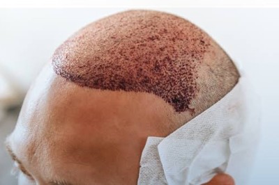 Hair Transplants in Dubai for Men and Women: What to Expect