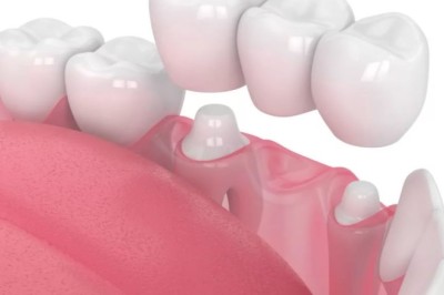 Dental Crown Dubai Procedure Explained Step by Step