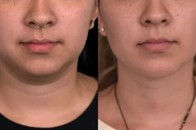 The Emotional Benefits of Double Chin Removal in Dubai