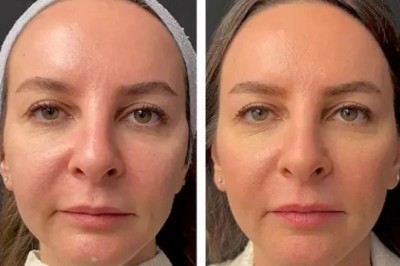 Best Plastic Surgeons in Dubai Explain the Benefits of Mesotherapy for Glowing Skin