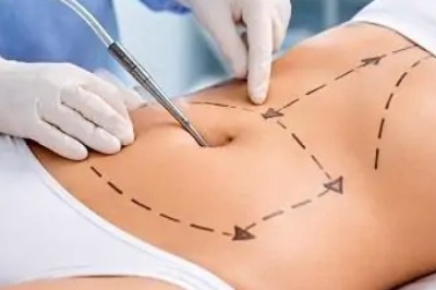 Effective Vibro Liposuction Solutions | Glamorous Clinic in Dubai
