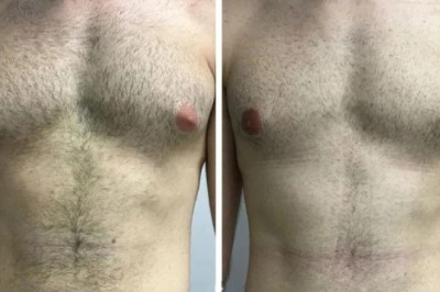 Gynecomastia in Dubai: Comparing Surgical and Non-Surgical Treatment Options