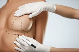 Breast Lift in Dubai (Mastopexy Surgery ...